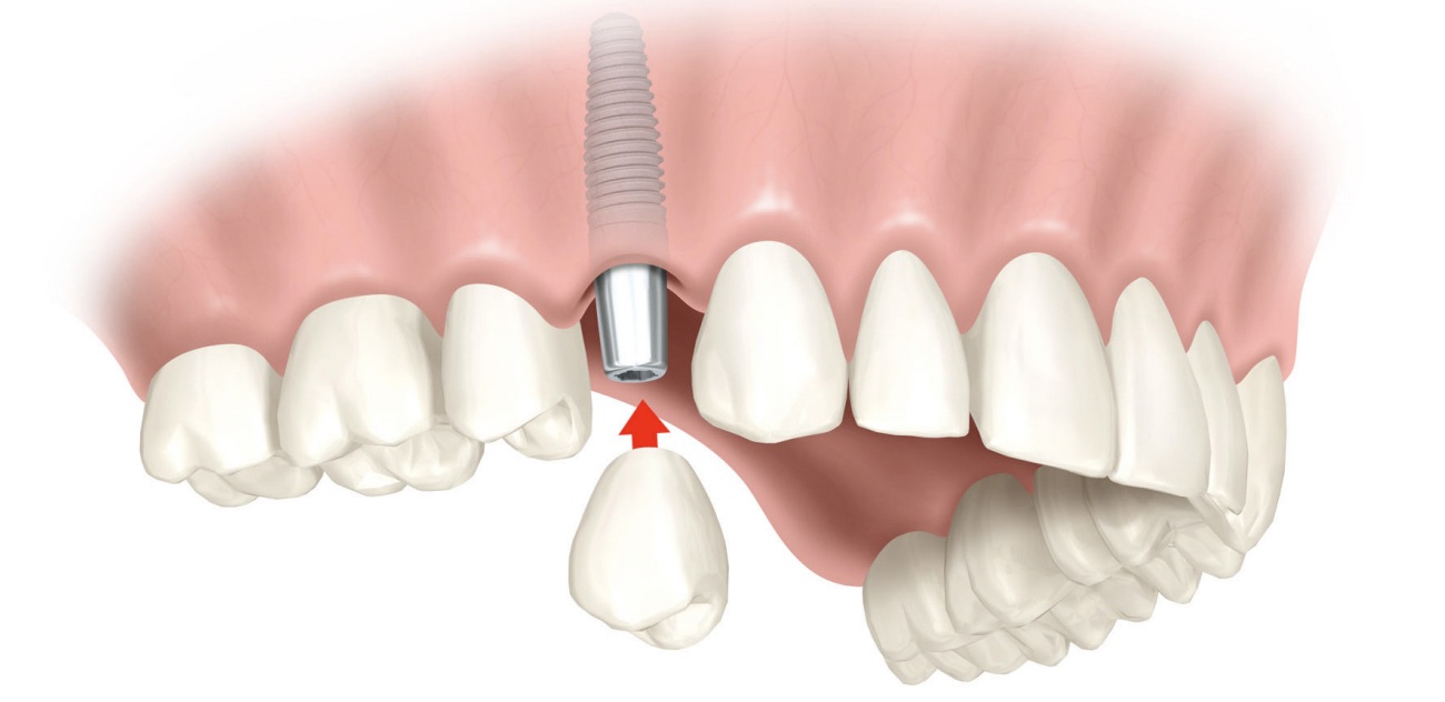 implante-dentario-em-londrina1